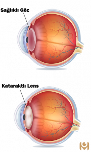 Sağlıklı Göz ve Kataraktlı Lens